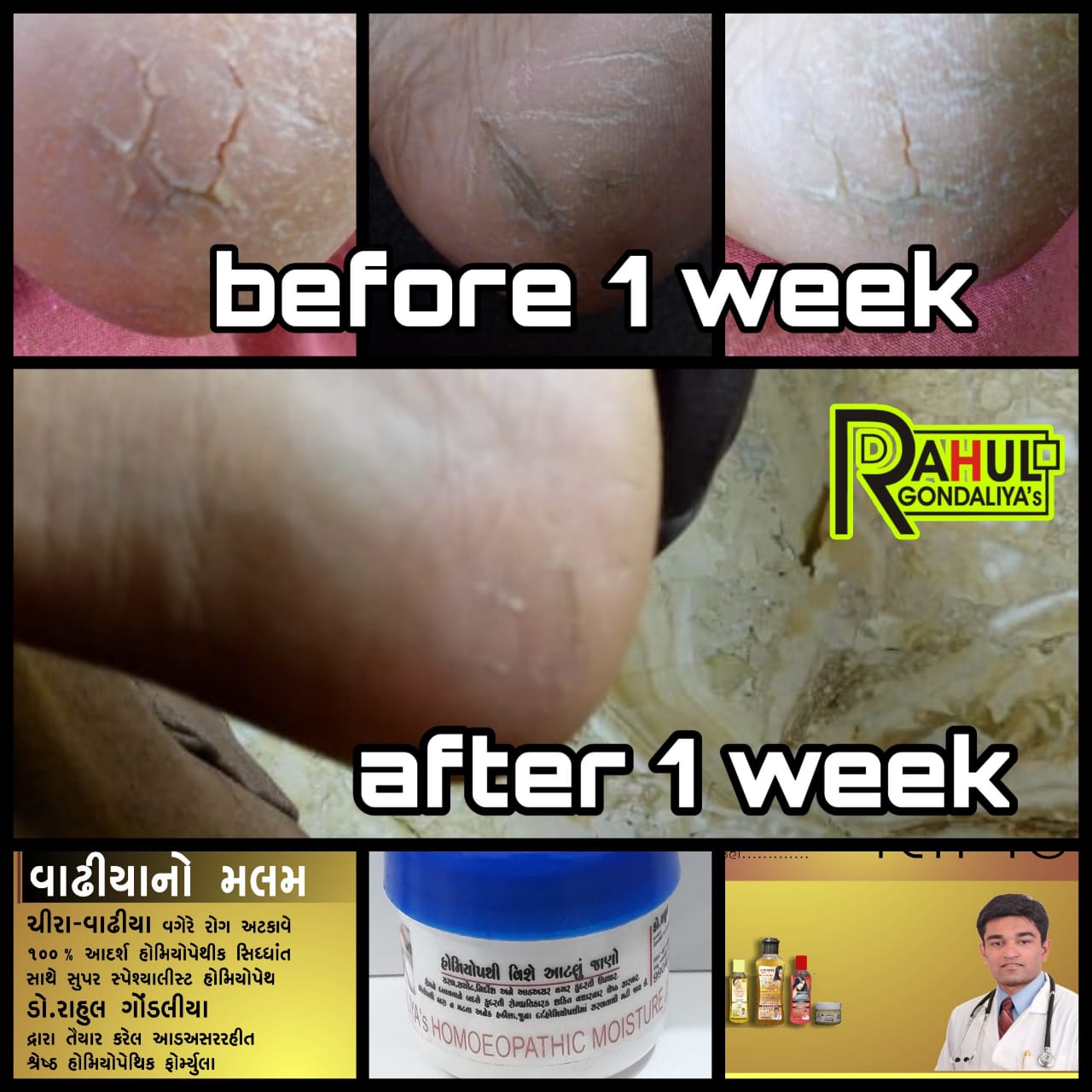 Dr GONDALIYA’s™ Homoeopathic Moisture Jelly - Foot Crack Cream